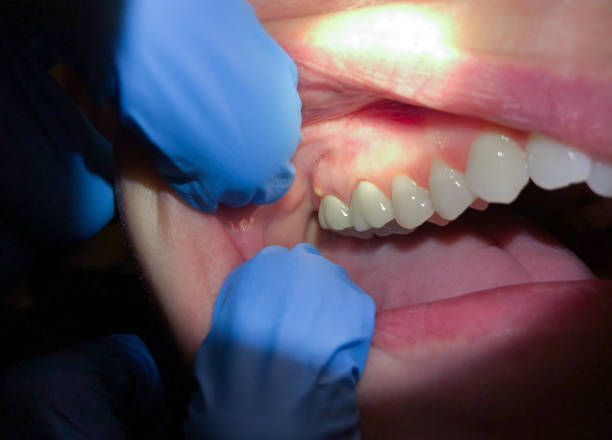 Best Emergency Wisdom Teeth Removal in Mercersburg, PA